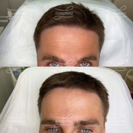 Ботулинотерапия области лба и глаз