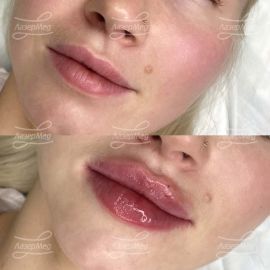 Контурная пластика губ
