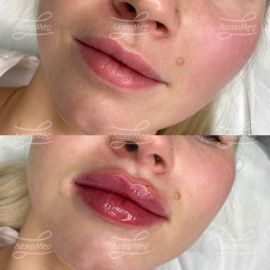 Контурная пластика губ