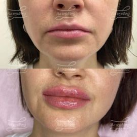 Контурная пластика губ