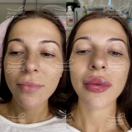 Контурная пластика губ