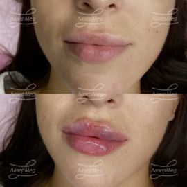 Контурная пластика губ