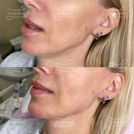 Коррекция нижней трети лица