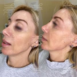 Коррекция нижней трети лица