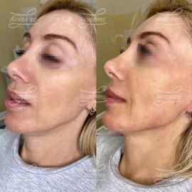 Коррекция нижней трети лица