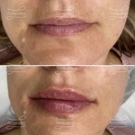 Контурная пластика губ