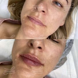 Контурная пластика губ