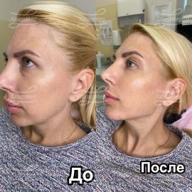 Коррекция углов нижней челюсти