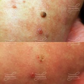 Удаление фибромы на плече (до и сразу после)