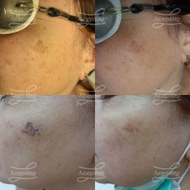 Удаление пигментного пятна (фото 1 - до, фото 2 - сразу после, фото 3 - на следующий день после удаления, потемнение и разрушение пигмента, шелушение; фото 4- через 7 дней после, пигмент отшелушится бесследно