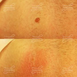 Удаление фибромы на шее (до и сразу после)