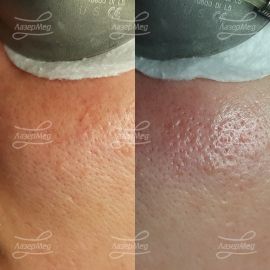 Удаление сосудов (до и сразу после)