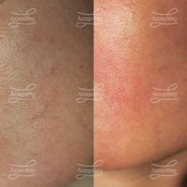 Удаление сосудов (до и сразу после)