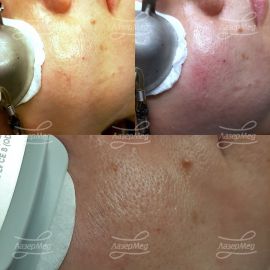 Удаление сосудов