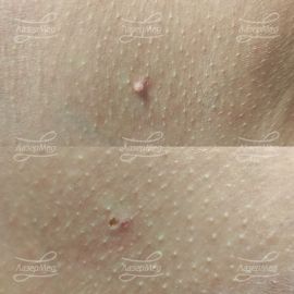 Лазерная деструкция фибромы