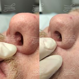 Лазерная деструкция вирусной бородавки