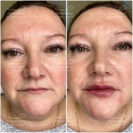 Коррекция губ и носогубных складок