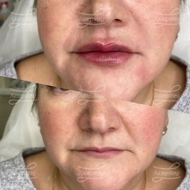 Коррекция губ и носогубных складок