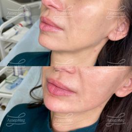 Коррекция губ и носогубных складок