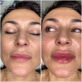 Контурная пластика губ