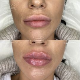 Коррекция губ