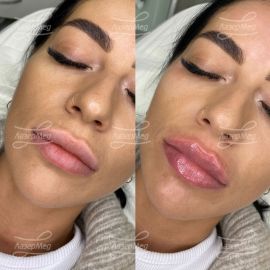 Коррекция губ