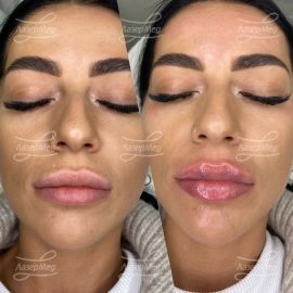 Коррекция губ