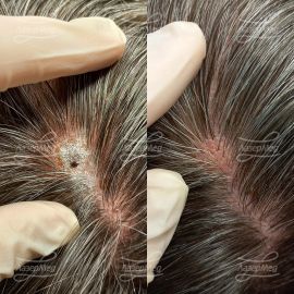 Удаление невуса на волосистой части головы