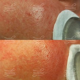 Удаление сосудов на лице