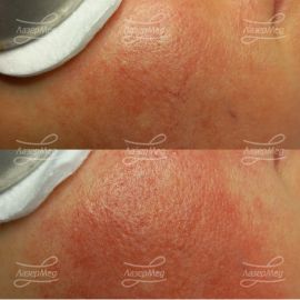 Удаление сосудов на лице