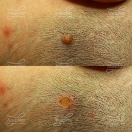 Удаление сложного невуса на волосистой части головы