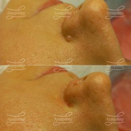 Удаление фибромы на крыле носа