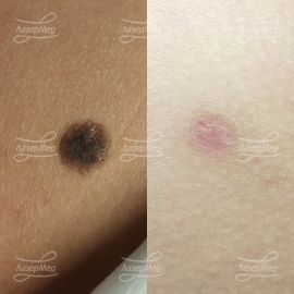 Лазерная деструкция кератомы на коже ягодичной области