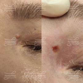 Лазерная деструкция невуса
