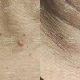 Лазерная деструкция мягкой фибромы