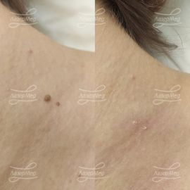 Лазерная деструкция папиллом