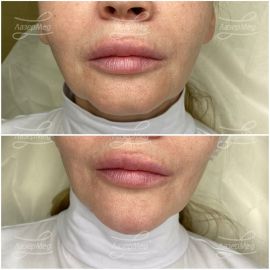 Коррекция подбородка