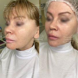 Коррекция подбородка