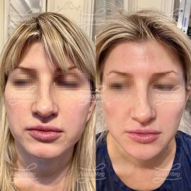 Коррекция подбородка и скул