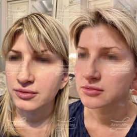 Коррекция подбородка и скул