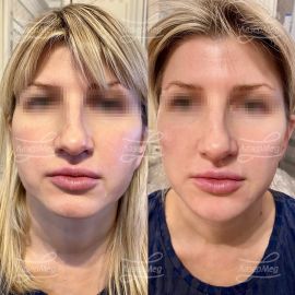 Коррекция подбородка и скул