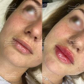 Контурная пластика подбородка и губ