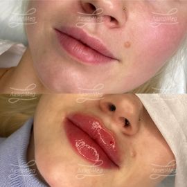 Контурная пластика губ