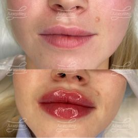 Контурная пластика губ