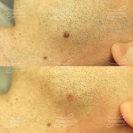 Удаление сложного невуса на лице