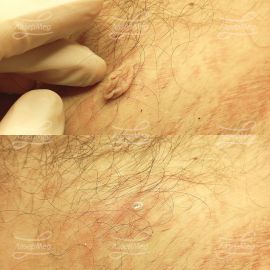 Удаление мягкой фибромы на теле