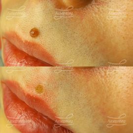 Удаление сложного невуса на лице