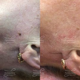 Удаление новообразования на лице