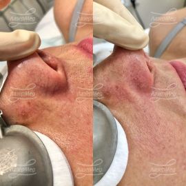 Удаление сосудов на крыльях носа