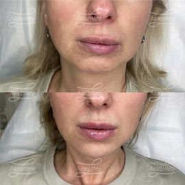 Коррекция подбородка